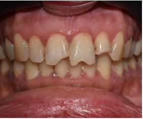 Image of Restoring Smile with Ceramic Veneers for a Patient with Fractured Anterior Teeth: A Case Report