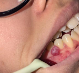 Image of Exploring Gingival Overgrowth Due to Epileptic Medication: A Case Report
