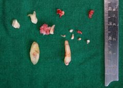 Image of Compound Odontoma in the Anterior Mandible: Diagnostic Challenges and Surgical Management of a Rare Presentation
