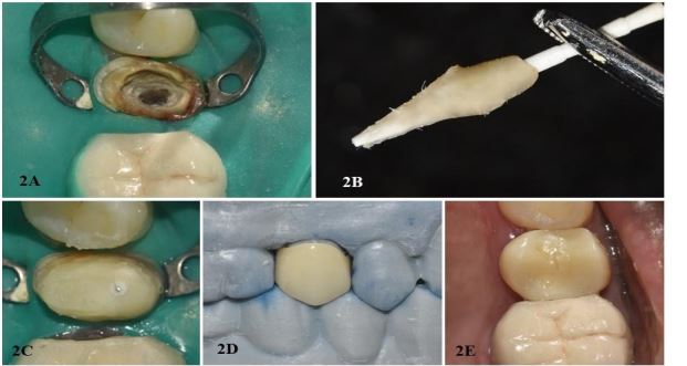 Image of Rehabilitation of a Grossly Decayed Premolar with a Custom Modified Fibre Post and Zirconia Crown