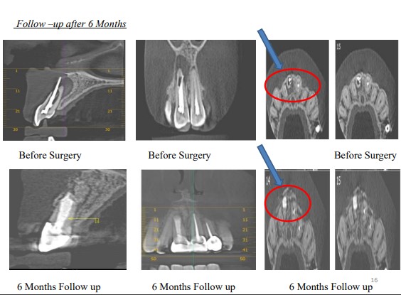 Image of Cone Beam Computed Tomography - Assisted Surgical Management of Root Canal Perforation