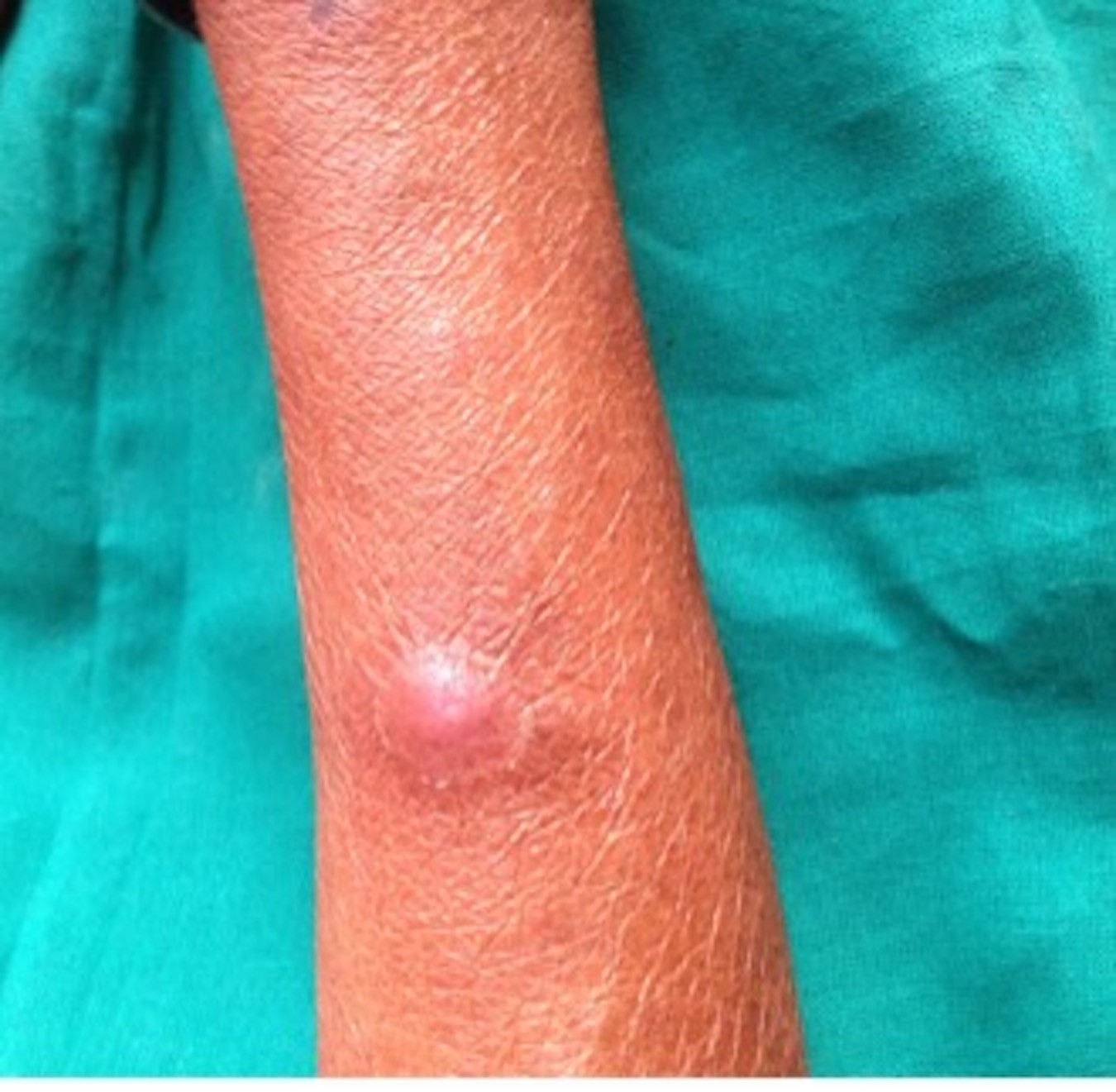 Image of HIV and its Oral Manifestations: Insights from a Case Report