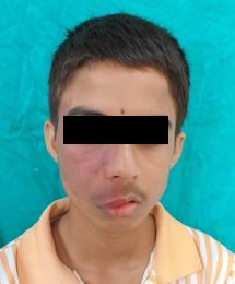 Image of Sturge Weber Syndrome: A Case Report