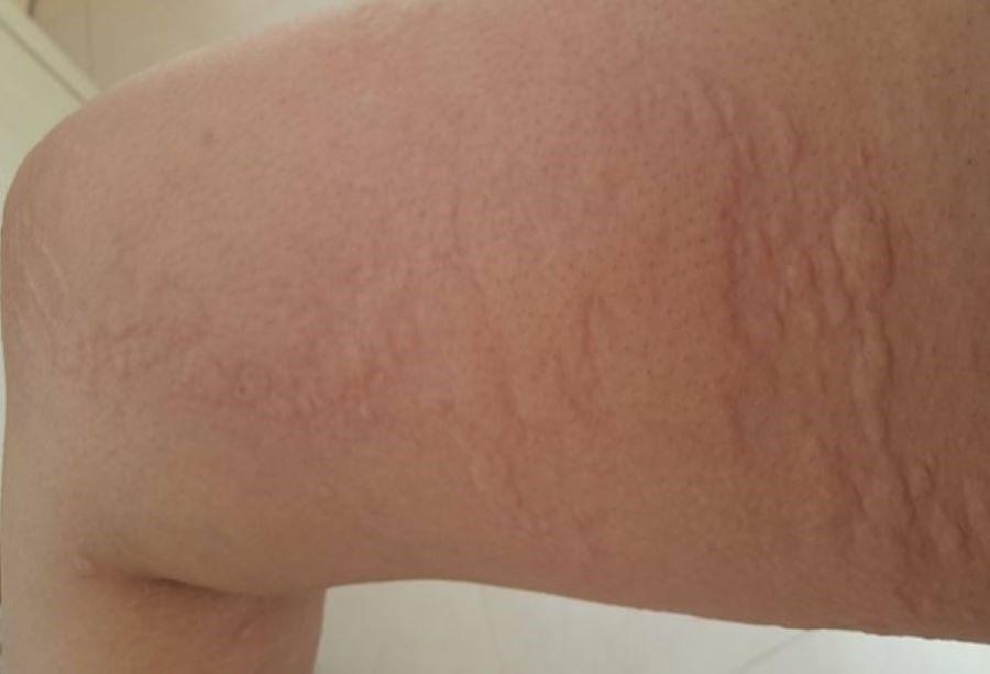 Image of Facial Urticaria Leading to Hypothyroidism Diagnosis: A Case Report