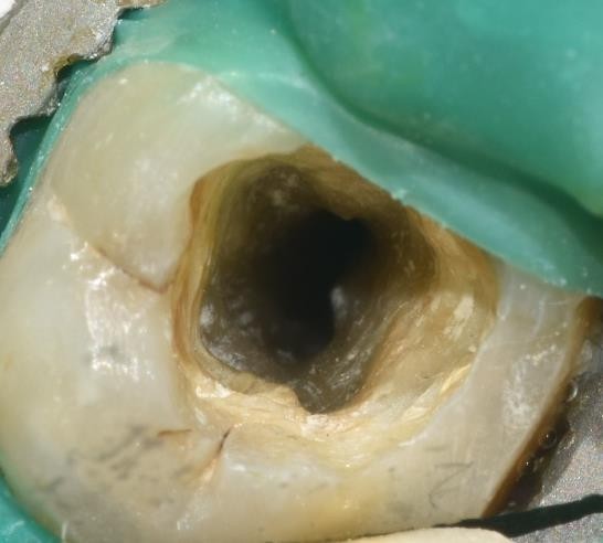 Image of Navigating the C-Shape Canals: A Case Series on Endodontic Treatment with Bio-ceramic Sealers