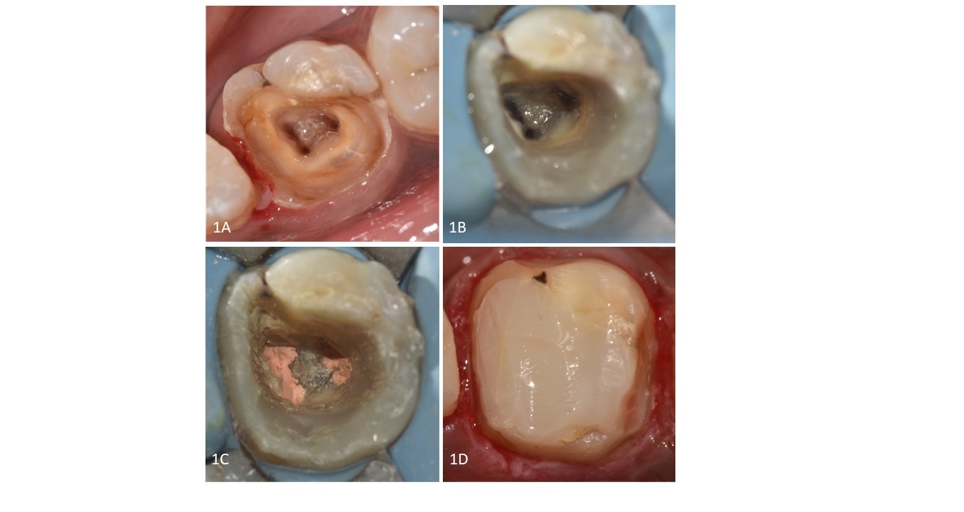 Image of Uncovering the Hidden: Identification of a Middle Mesial Canal in a Mandibular Molar Under Magnification: A Case Report
