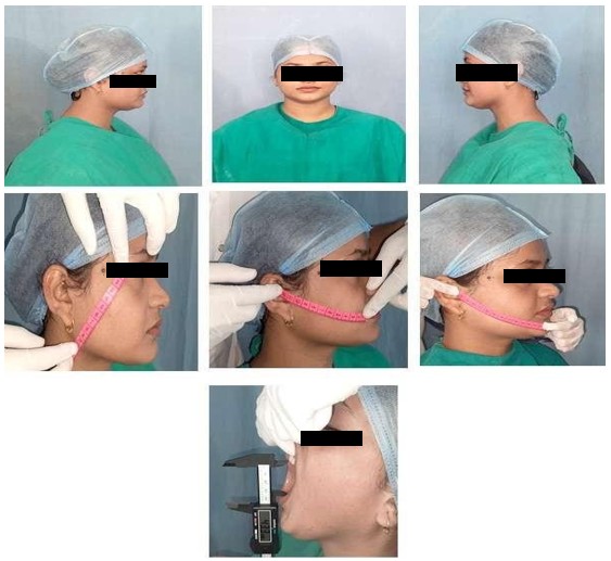 Image of Comparative Evaluation of Dexamethasone and Methylprednisolone for Pain, Swelling, and Trismus After Mandibular Third Molar Surgery: A Prospective Randomized Clinical Study