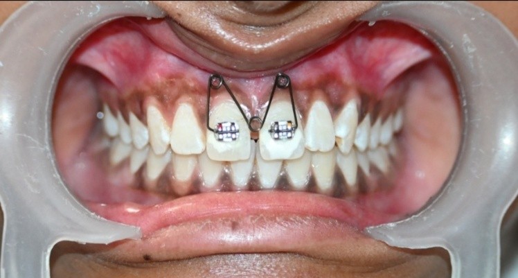 Image of Closure of Midline Diastema Following Frenectomy with M-Spring: A Case Report